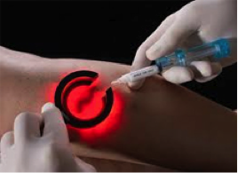 Transilluminated Sclerotherapy for spider vein removal Transilluminated Sclerotherapy for spider vein removal