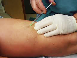 Sclerotherapy for spider vein removal Sclerotherapy for spider vein removal
