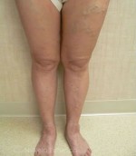 Foam Sclerotherapy