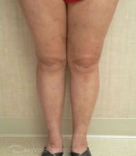 Foam Sclerotherapy