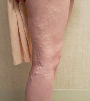 Foam Sclerotherapy