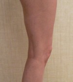 Foam Sclerotherapy