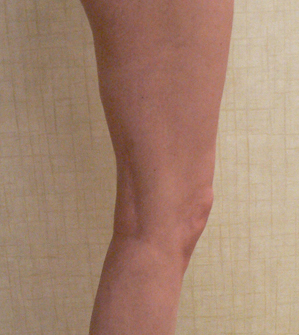 Foam Sclerotherapy