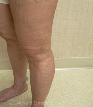 Foam Sclerotherapy