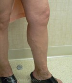 Foam Sclerotherapy