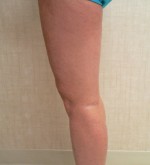 Foam Sclerotherapy