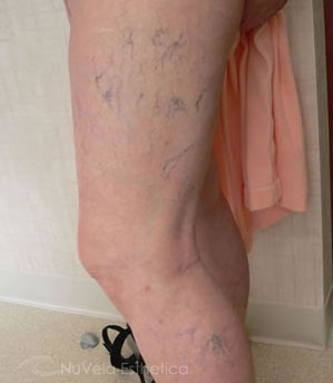 Sclerotherapy Photos