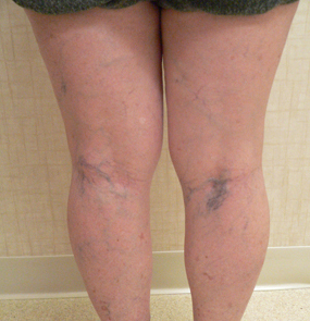 Sclerotherapy Photos