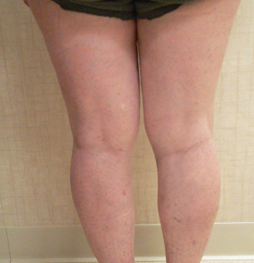 Sclerotherapy Photos