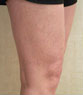 Sclerotherapy Photos