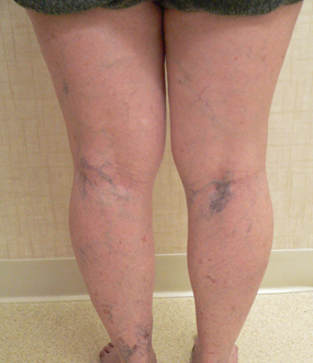 Sclerotherapy Photos