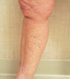 Sclerotherapy Photos