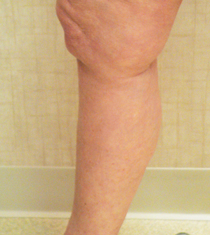 Sclerotherapy Photos