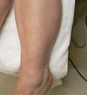 Sclerotherapy Photos