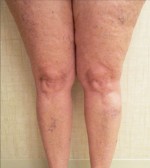 Sclerotherapy Photos