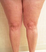 Sclerotherapy Photos