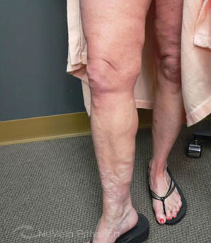 Varicose Veins