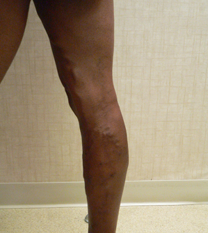 Varicose Veins