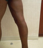 Varicose Veins