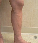 Varicose Veins