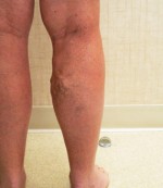 Varicose Veins