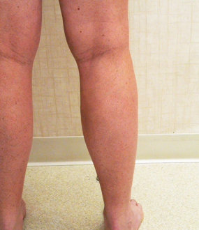 Varicose Veins