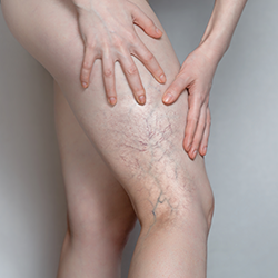 Woman shows leg with varicose veins