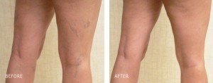 Before and After Sclerotherapy Treatment Before and After Sclerotherapy Treatment