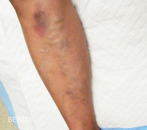 Varicose Veins