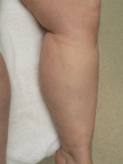 Varicose Veins