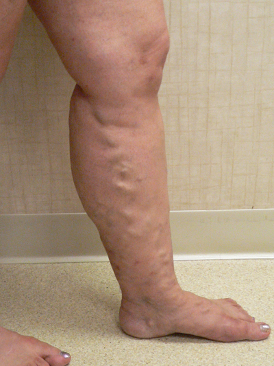 Varicose Veins