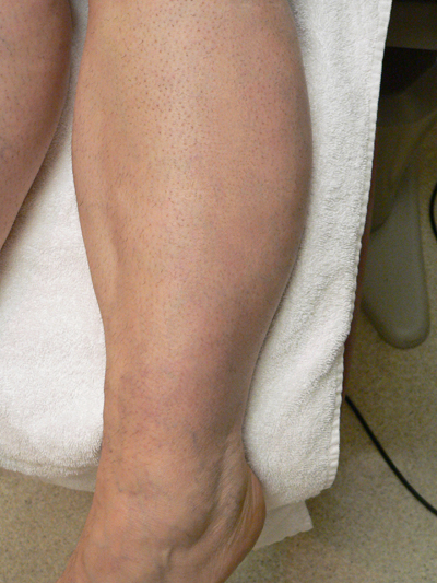 Varicose Veins