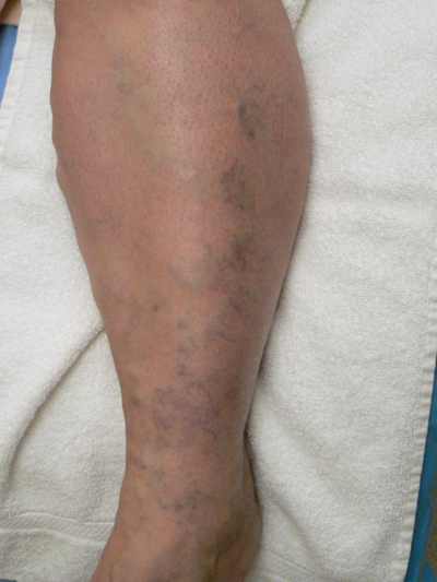 Varicose Veins