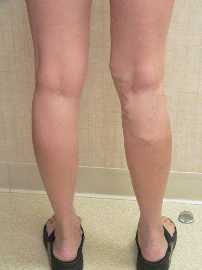 Varicose Veins