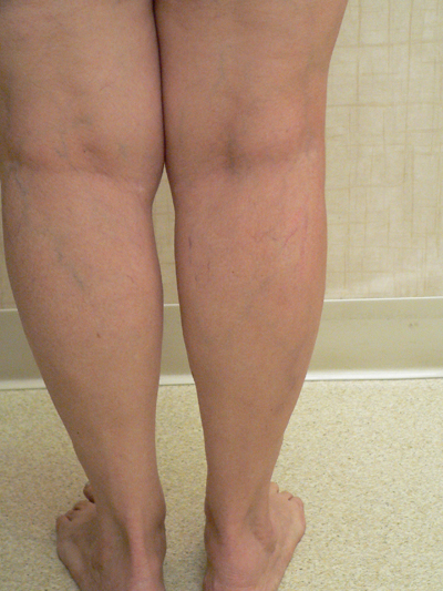 Varicose Veins