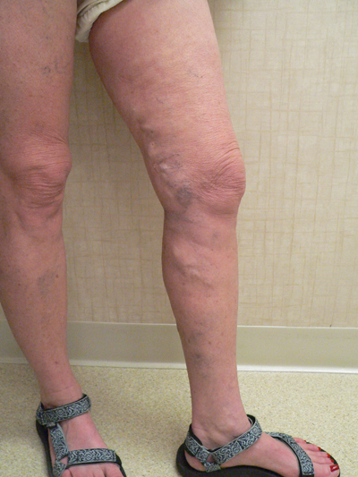 Varicose Veins