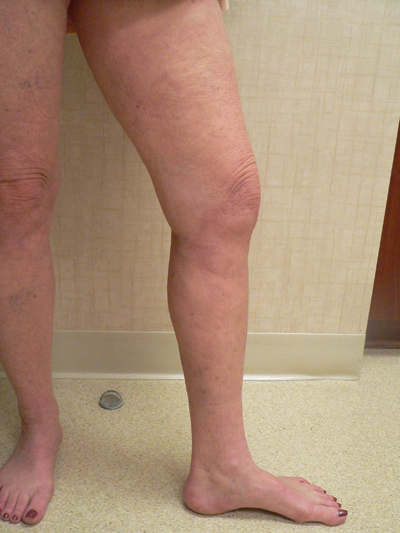 Varicose Veins