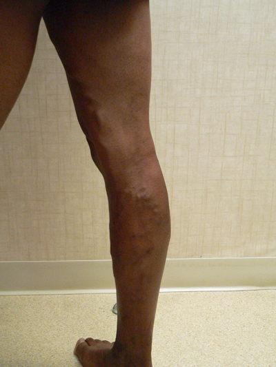 Varicose Veins