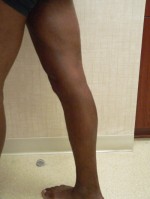 Varicose Veins