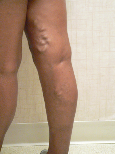 Varicose Veins