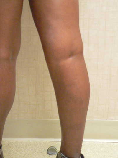 Varicose Veins