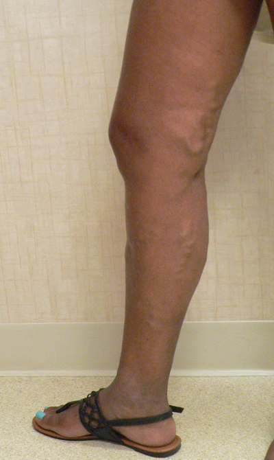 Varicose Veins