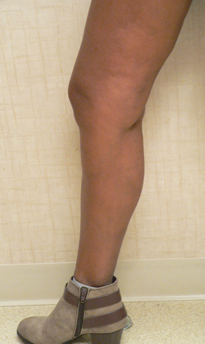 Varicose Veins