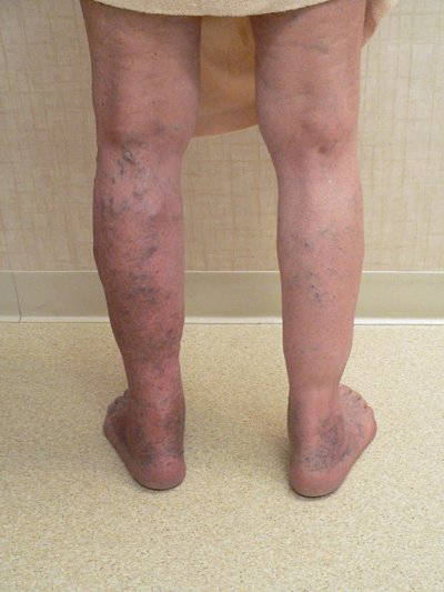 Varicose Veins