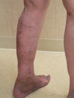 Varicose Veins