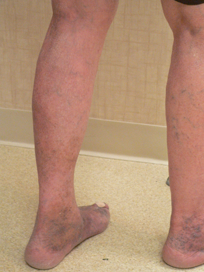 Varicose Veins