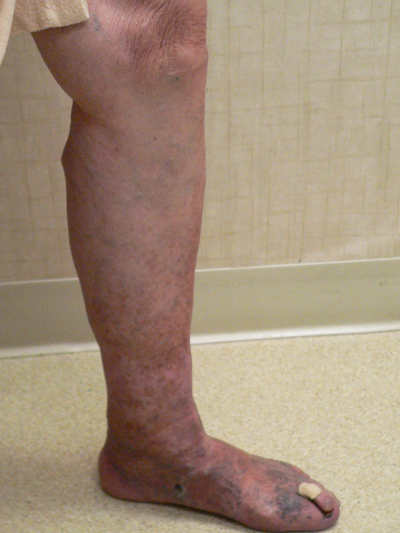 Varicose Veins