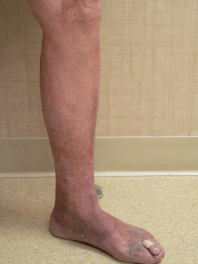 Varicose Veins