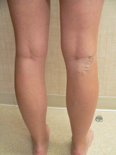 Varicose Veins