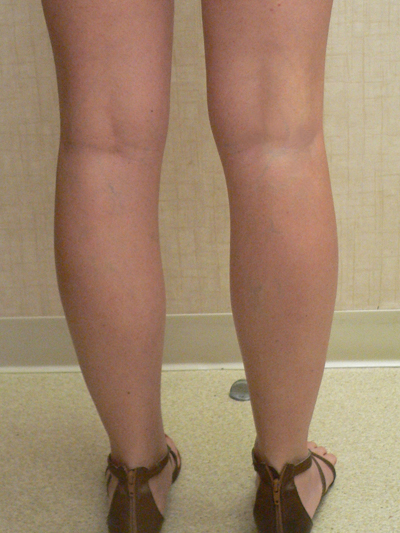 Varicose Veins